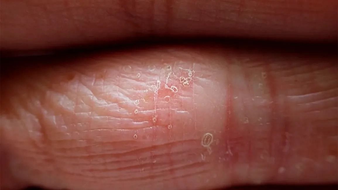 Dyshidrotic-eczema (Image via Getty Images)